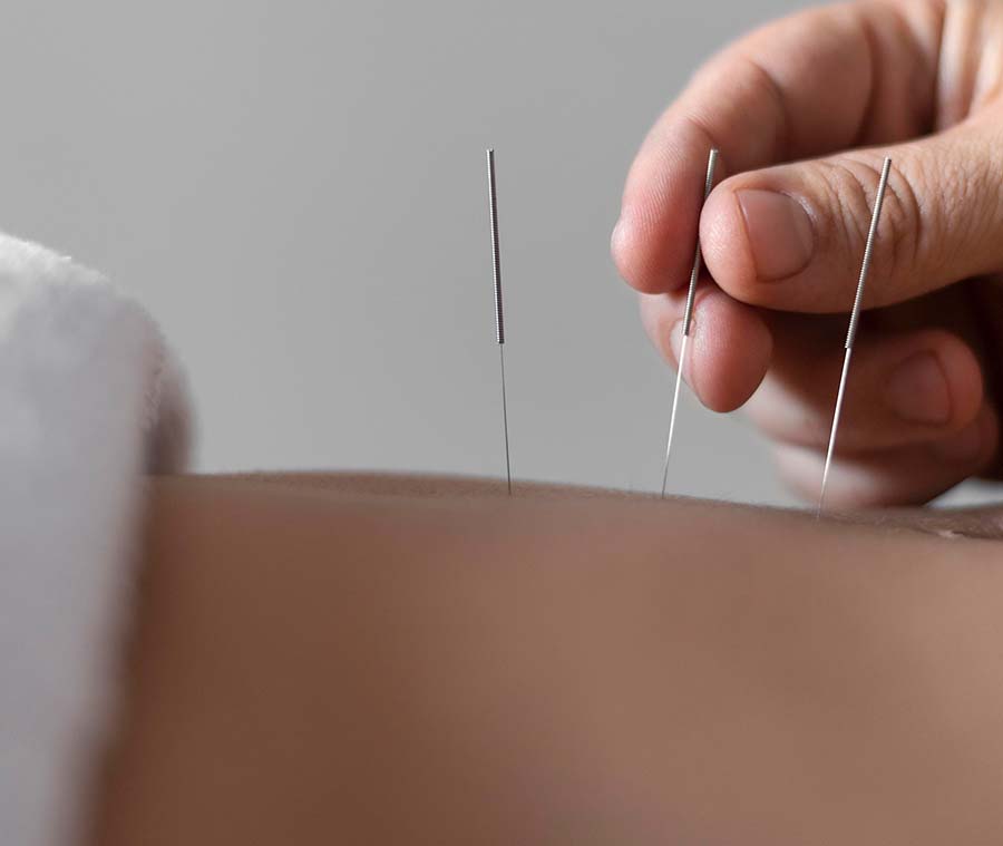 Denver acupuncture