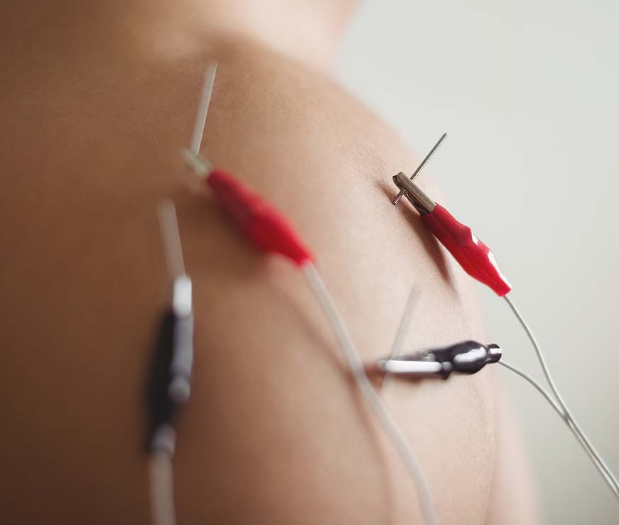 Cost of acupuncture treatment