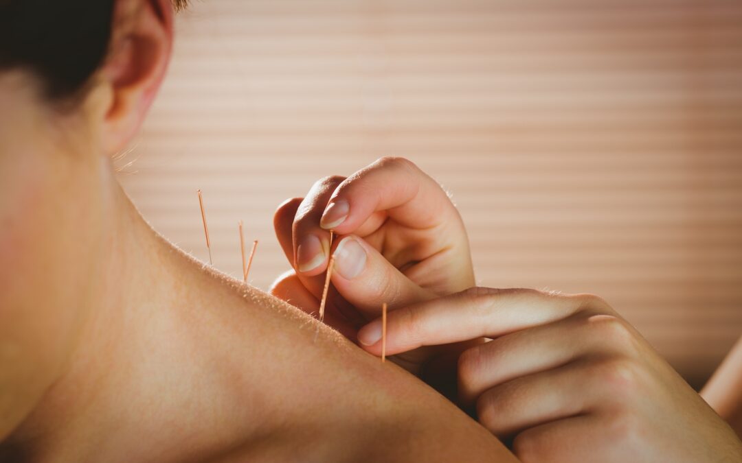 Exploring the Modern Benefits of Acupuncture